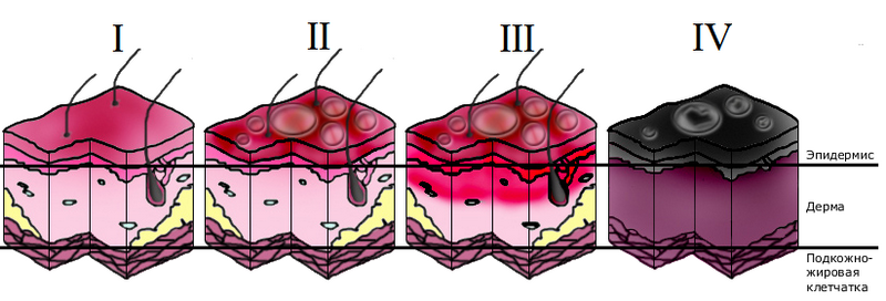 ступеня ожогов