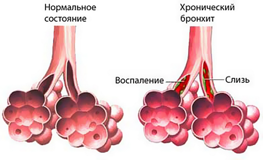 запалення