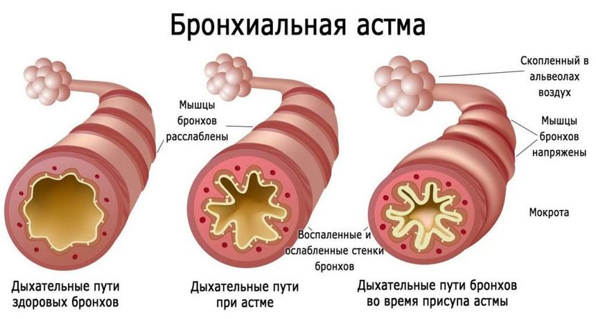 Бронхіальна астма