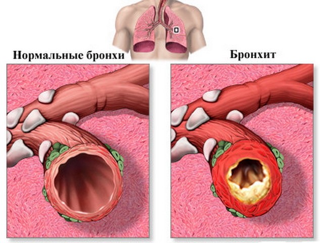 форма бронхіту