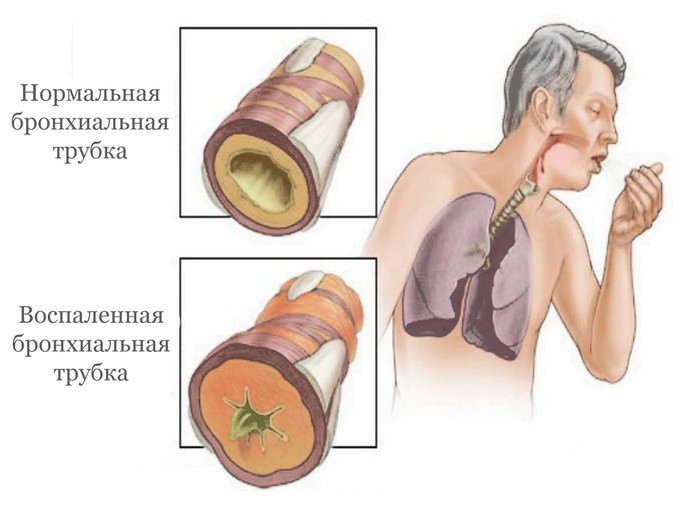 бронхіт