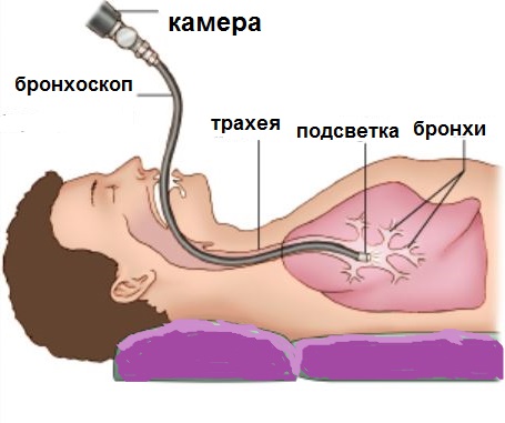 бронхоскопія