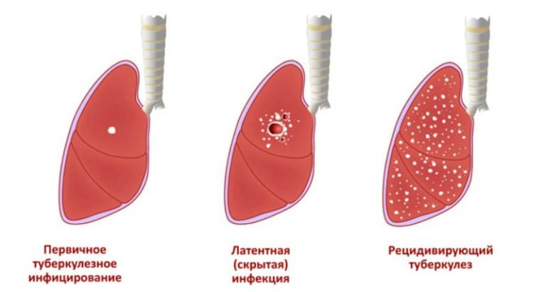 туберкульоз