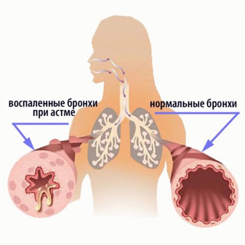 Схема здорових і хворих бронхів