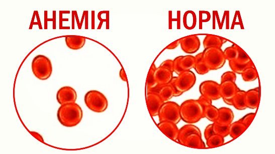 анемія