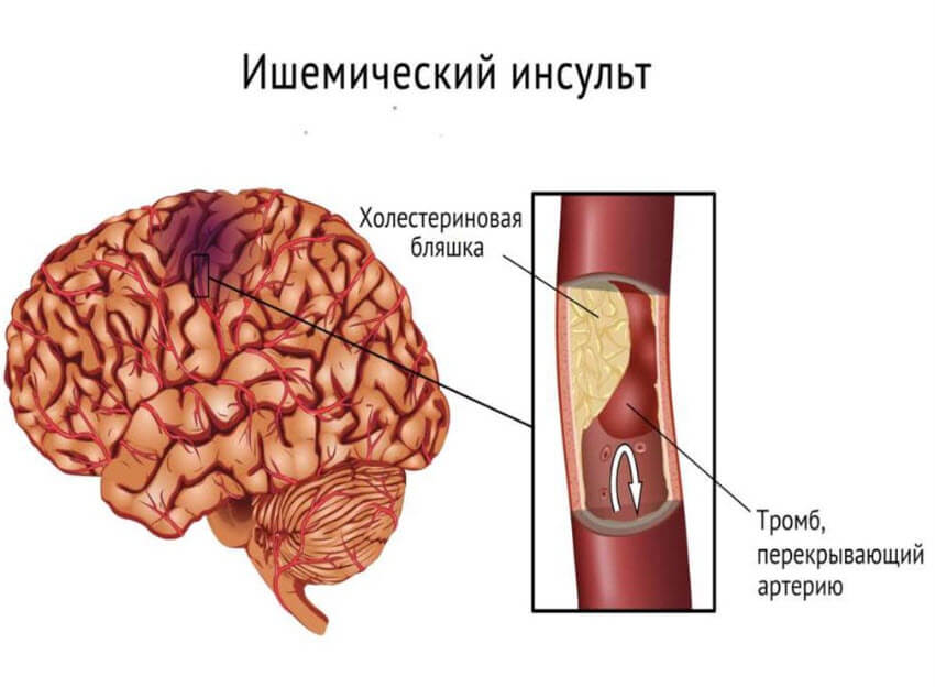 Ішемічний інсульт