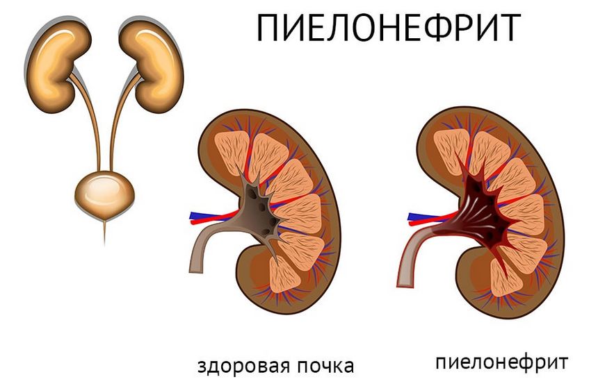 пієлонефрит