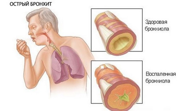 Гострий бронхіт