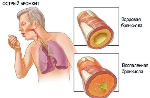 Гострий бронхіт