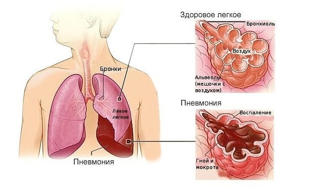 пневмонія