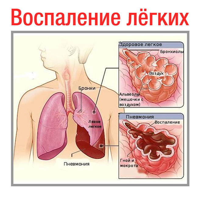 запаленні легенів