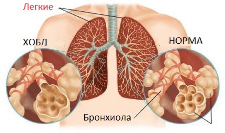 Запалення легенів