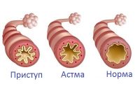 Бронхи при астмі