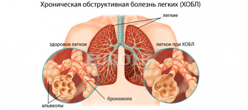 Легкі при ХОЗЛ