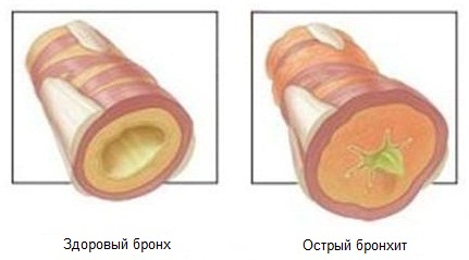 Гостра форма бронхіту