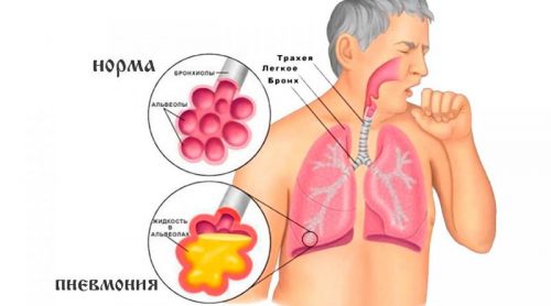 пневмонія