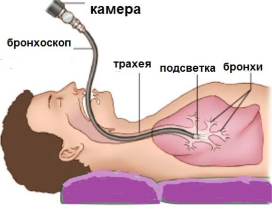 бронхоскопія