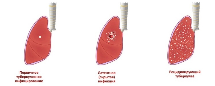стадії туберкульозу