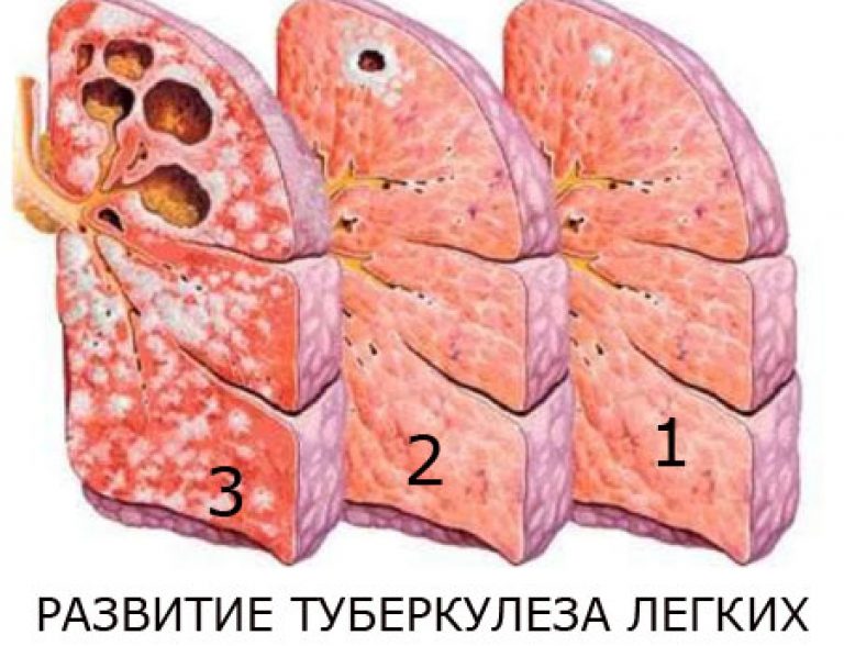 розвиток туберкульозу