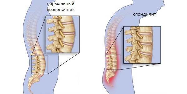 туберкульоз хребта