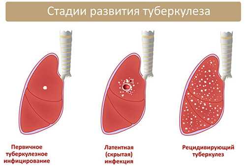 розвиток туберкульозу