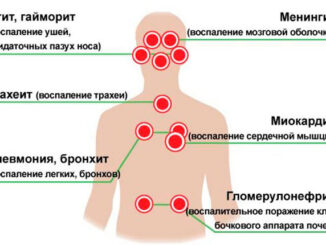 осложнения после гриппа